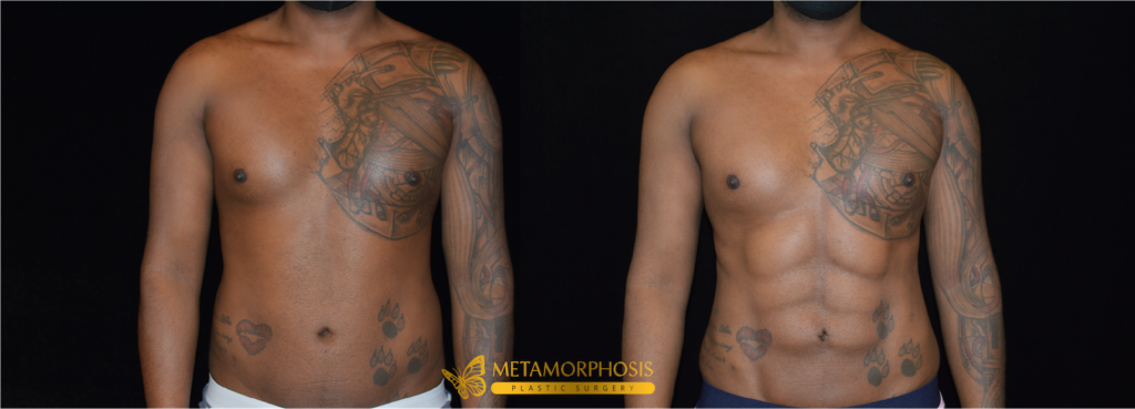 Six Pack Abs Before & After Patient #2282