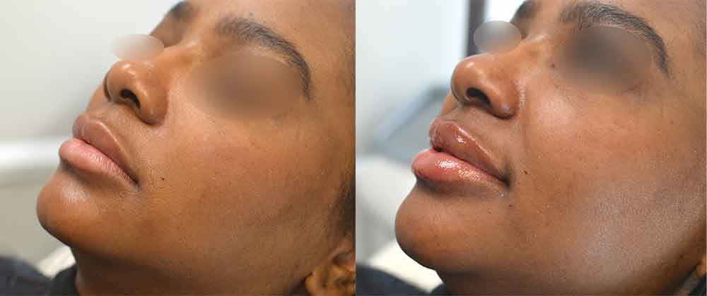 Lip Filler Before & After Patient #2440