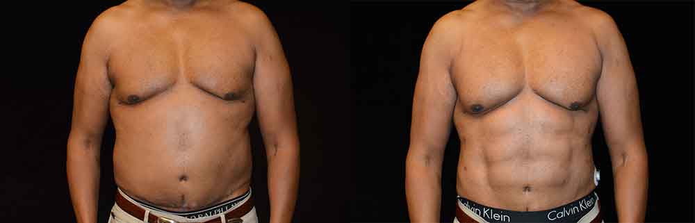 Six Pack Abs Before & After Patient #2451