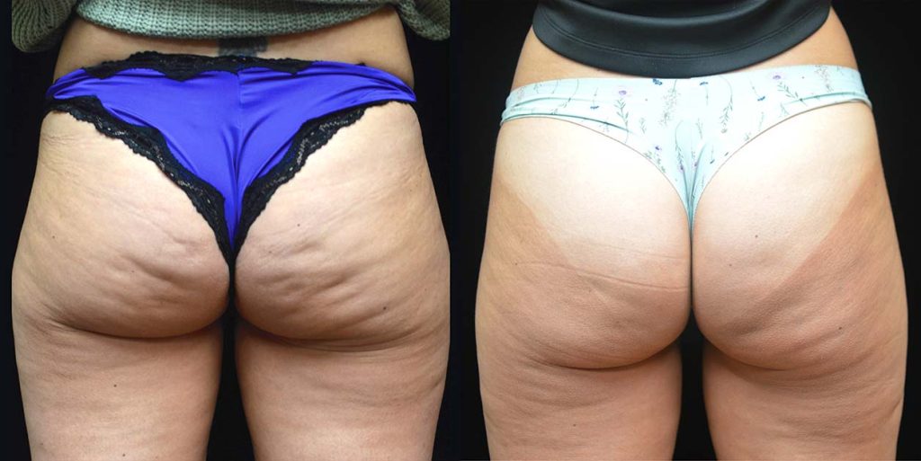 Before and after image of buttocks showing Dr. Daniel Markmann and his teams QWO treatment results at Discover the Beauty.