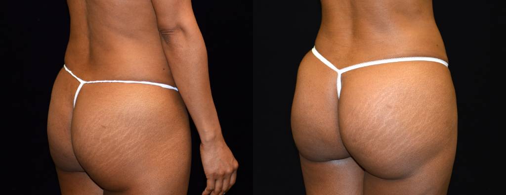 Brazilian Butt Lift Before & After Patient #2508