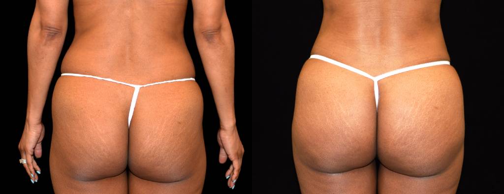 Brazilian Butt Lift Before & After Patient #2508