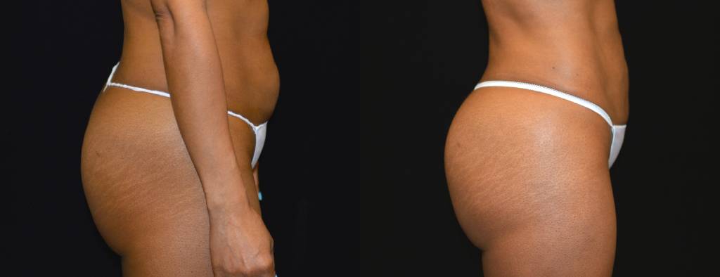 Brazilian Butt Lift Before & After Patient #2508