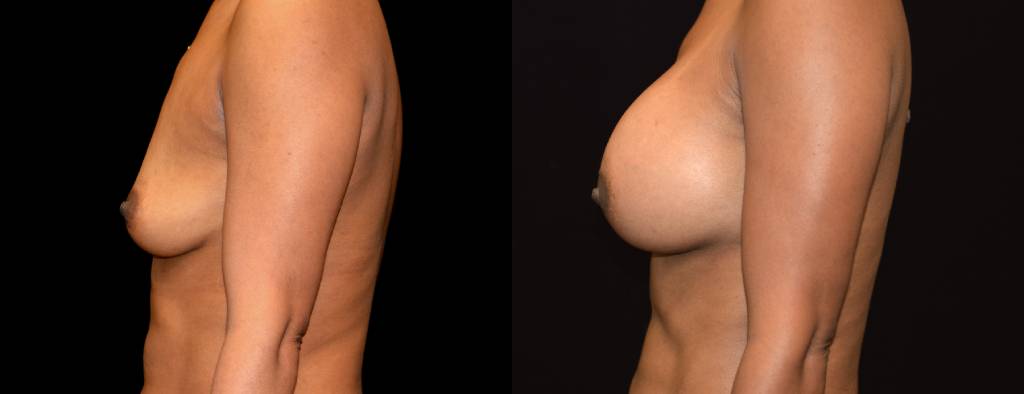 Breast Augmentation Before & After Patient #2513