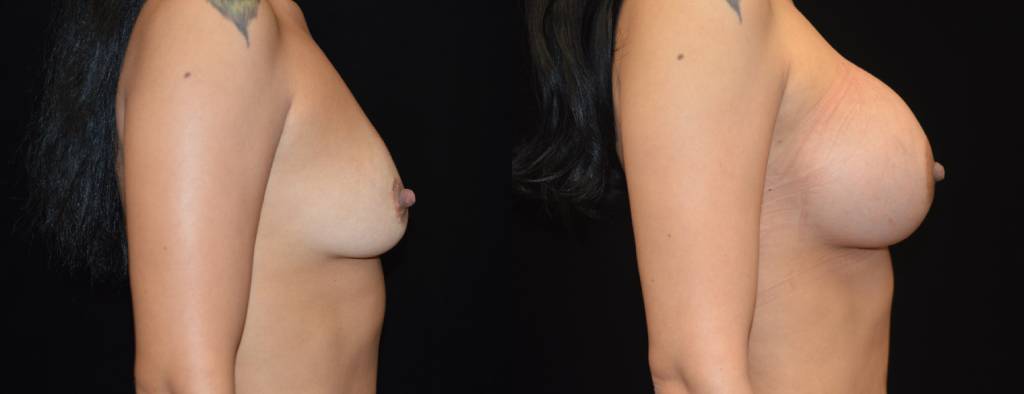 Breast Augmentation Before & After Patient #2516