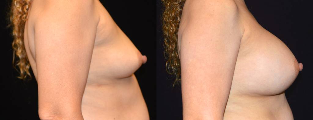 Breast Augmentation Before & After Patient #2519