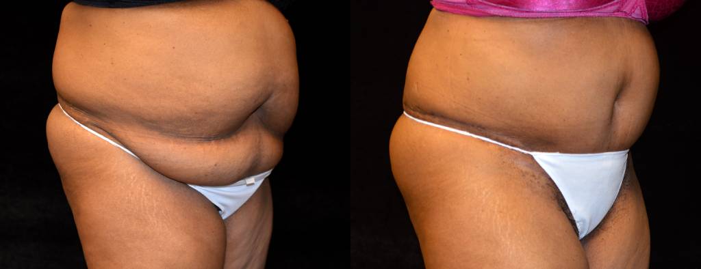 Tummy Tuck Before & After Patient #2522