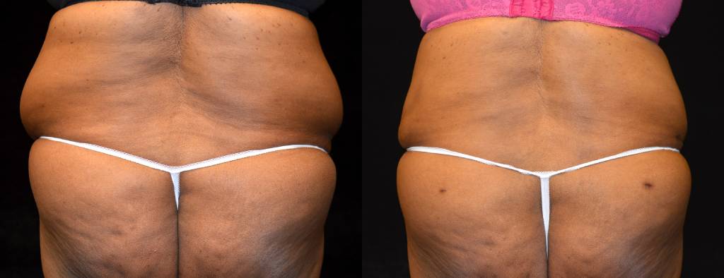 Tummy Tuck Before & After Patient #2522