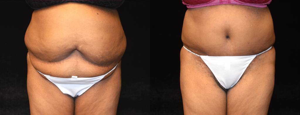 Six Pack Abs Before and After Photos Baltimore - Plastic Surgery Gallery  Columbia - Dr. Daniel Markmann