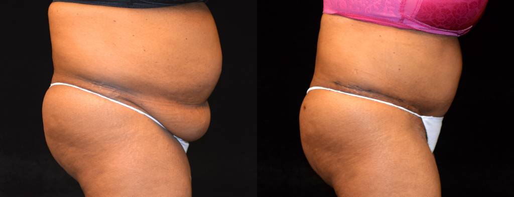 Tummy Tuck Before & After Patient #2522