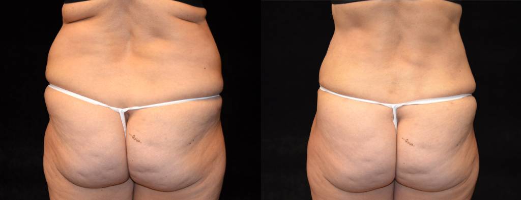 Tummy Tuck Before & After Patient #2527