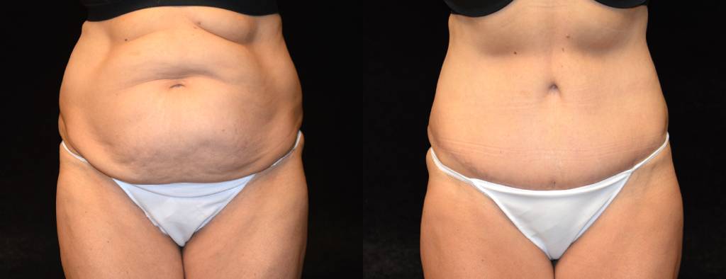 Tummy Tuck Before & After Patient #2527