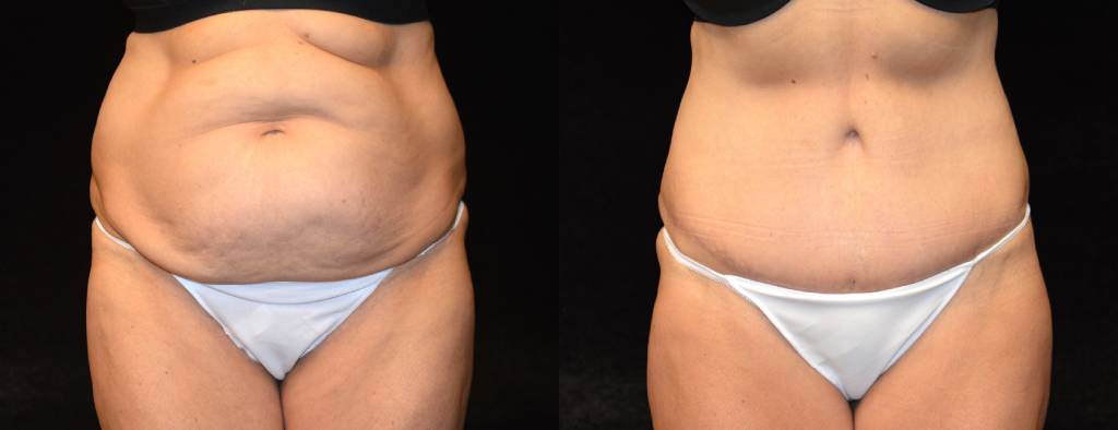 Six Pack Abs Before and After Photos Baltimore - Plastic Surgery Gallery  Columbia - Dr. Daniel Markmann