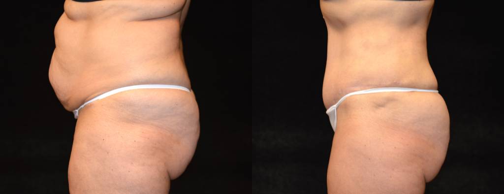Tummy Tuck Before & After Patient #2527