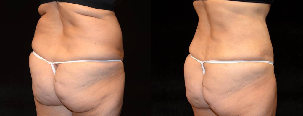 Tummy Tuck Before & After Patient #2527