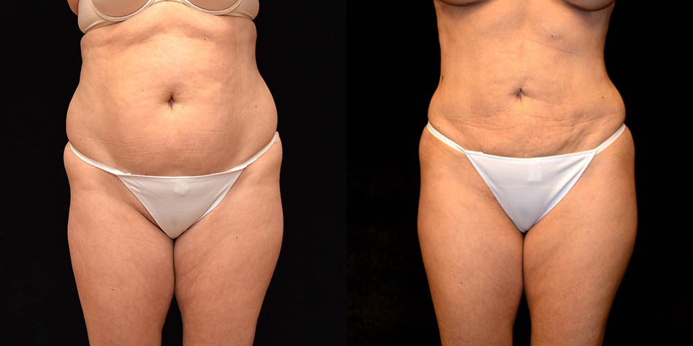 Liposuction Before & After Patient #2754