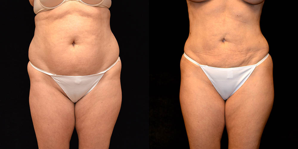 3,935 Liposuction Black Woman Images, Stock Photos, 3D objects, & Vectors