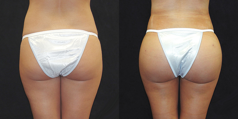 Brazilian Butt Lift Before & After Patient #2762