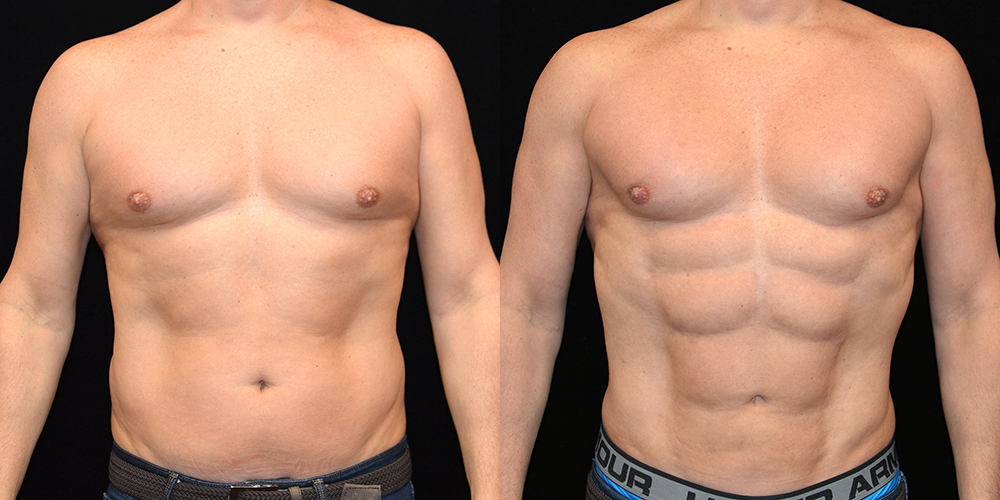 Six Pack Abs Before & After Patient #2763