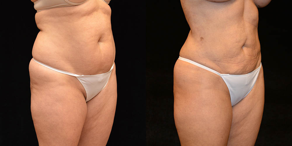 Liposuction Before & After Gallery