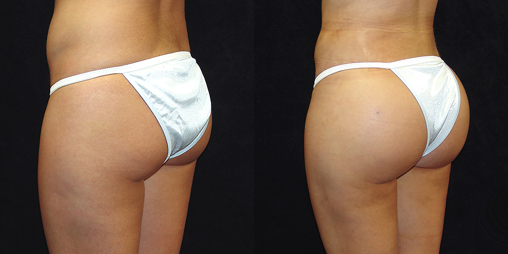 Brazilian Butt Lift Before & After Patient #2762