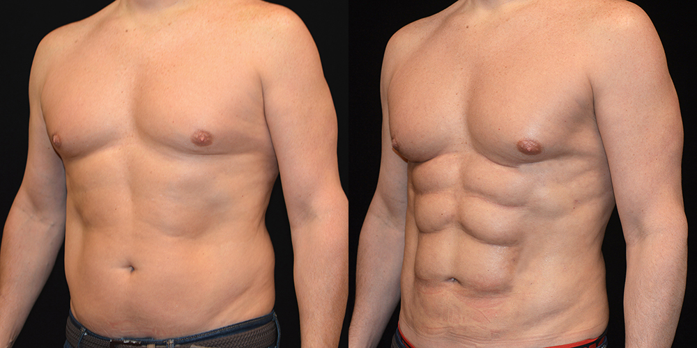 Abdominal Etching (Six Pack Abs) Maryland, Baltimore