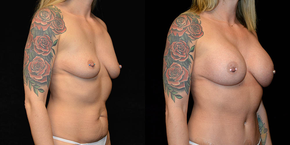 Breast Augmentation Before & After Patient #2753