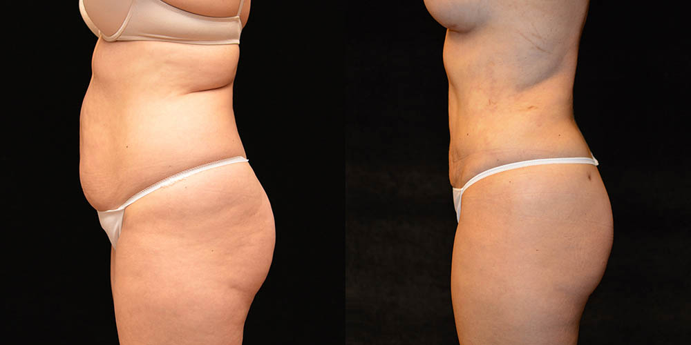 Tummy Tuck Before and After Photos Baltimore - Plastic Surgery Gallery  Columbia - Dr. Daniel Markmann