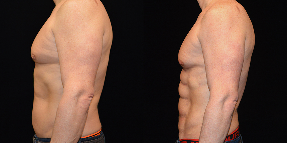 Six Pack Abs Before & After Patient #2763