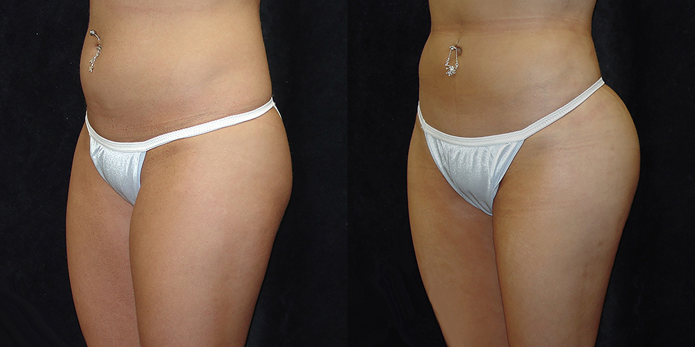 Brazilian Butt Lift Before & After Patient #2762