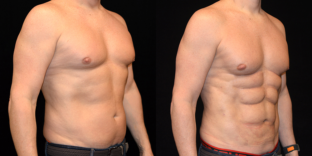 Six Pack Abs Before & After Patient #2763
