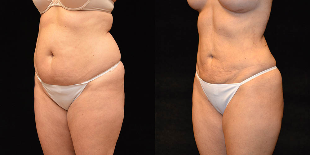 Liposuction Before & After Patient #2754