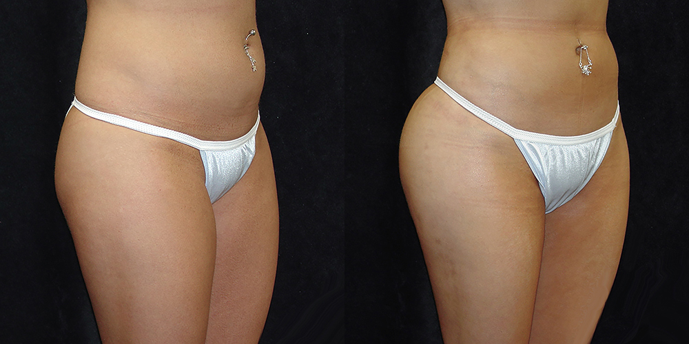 Brazilian Butt Lift Before & After Patient #2762