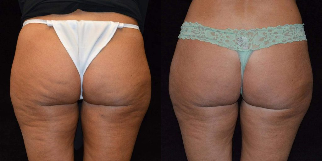 Cellulite Subcision Before & After Patient #3328