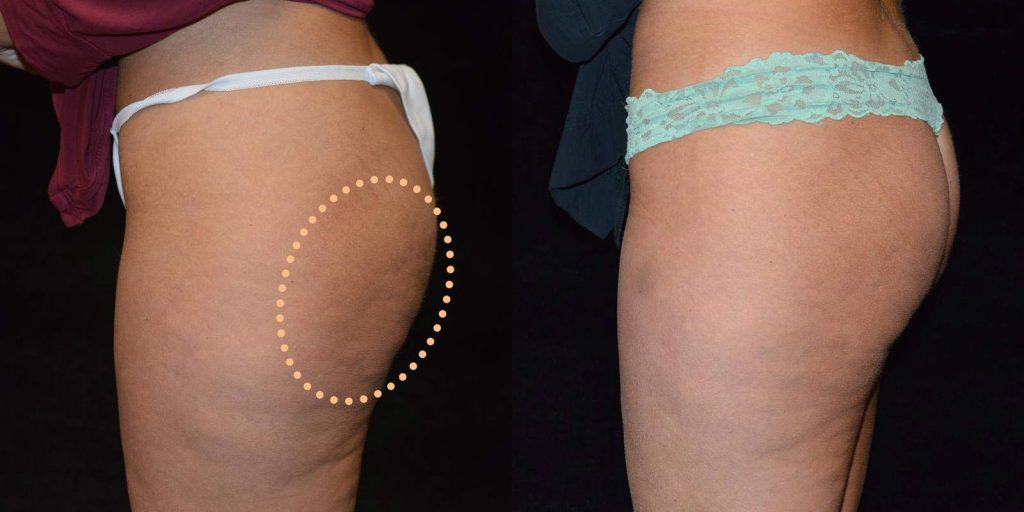 Cellulite Subcision Before & After Patient #3328