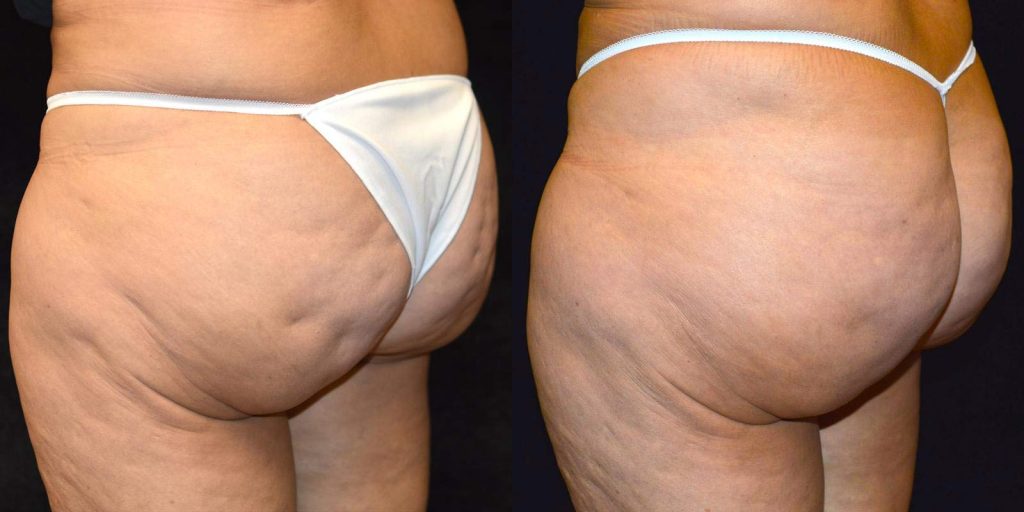 Cellulite Subcision Before & After Patient #3329