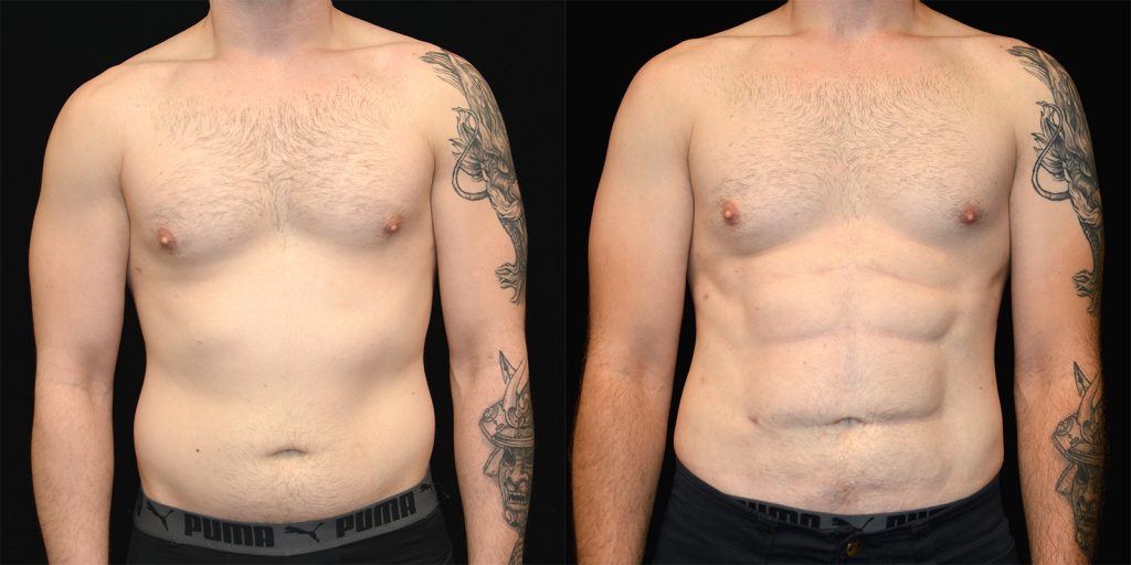 Ab Etching Before & After Patient #3355