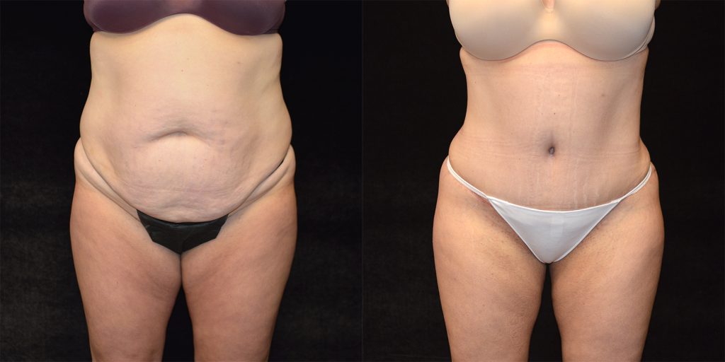 Brazilian Butt Lift Before & After Patient #3360