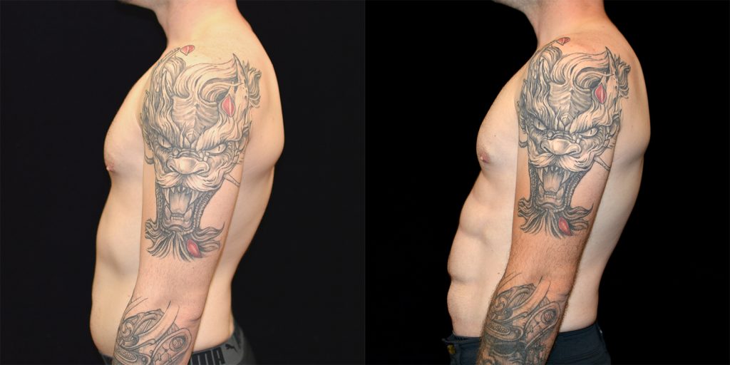 Ab Etching Before & After Patient #3355