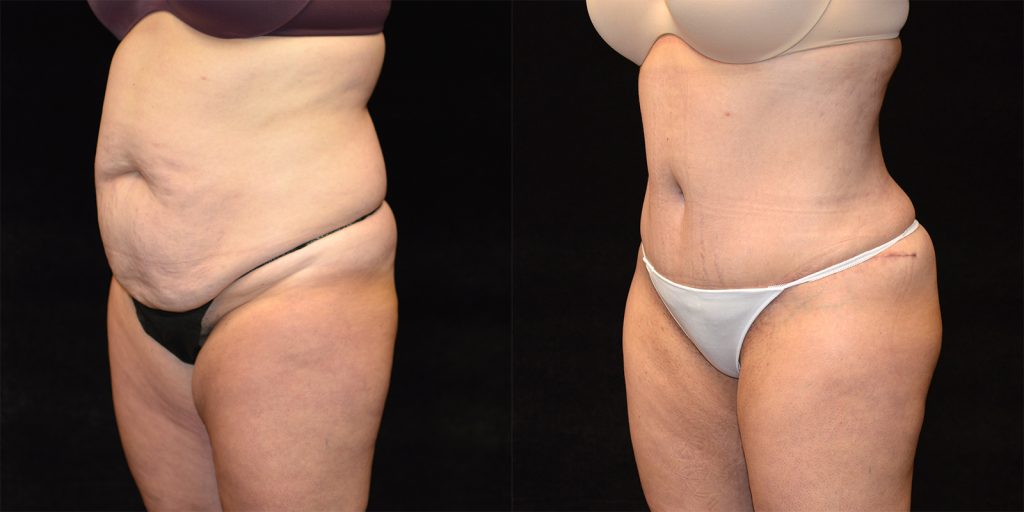 Brazilian Butt Lift Before & After Patient #3360