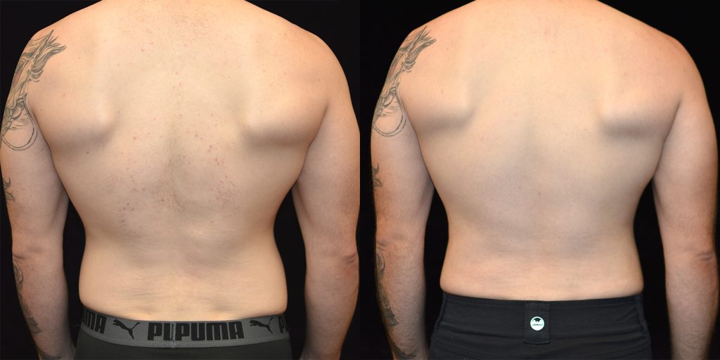 Ab Etching Before & After Patient #3355