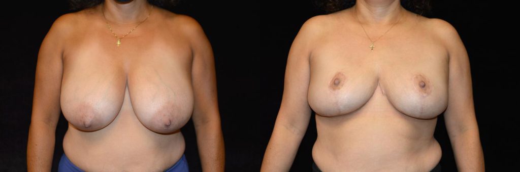 Breast Reduction Before & After Patient #3351