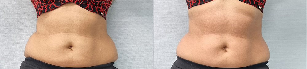 Artemis T-Shape 2 Before & After Patient #3942