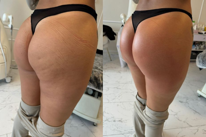 Artemis T-Shape 2 Before & After Patient #3915