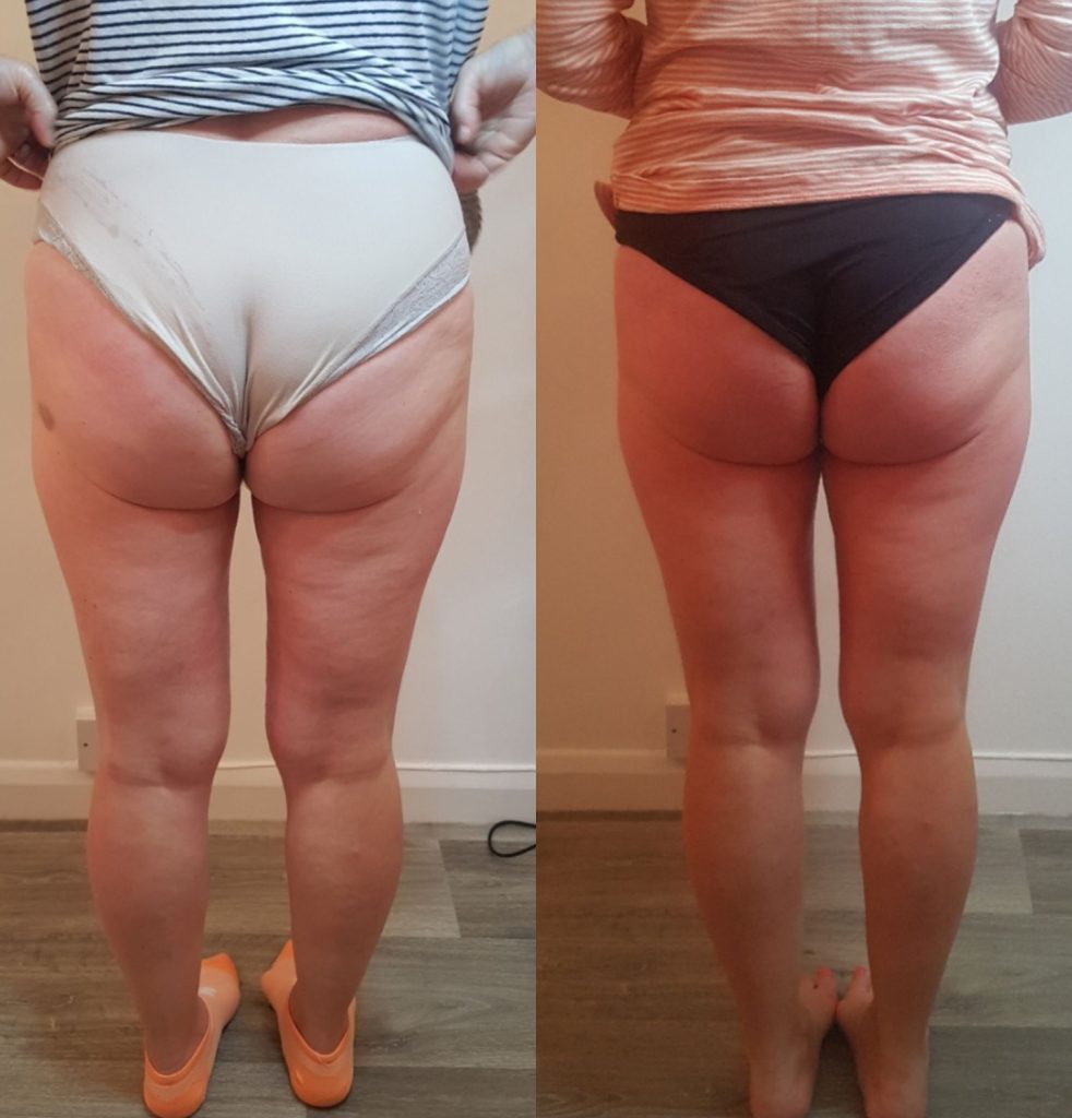 Artemis T-Shape 2 Before & After Patient #3956