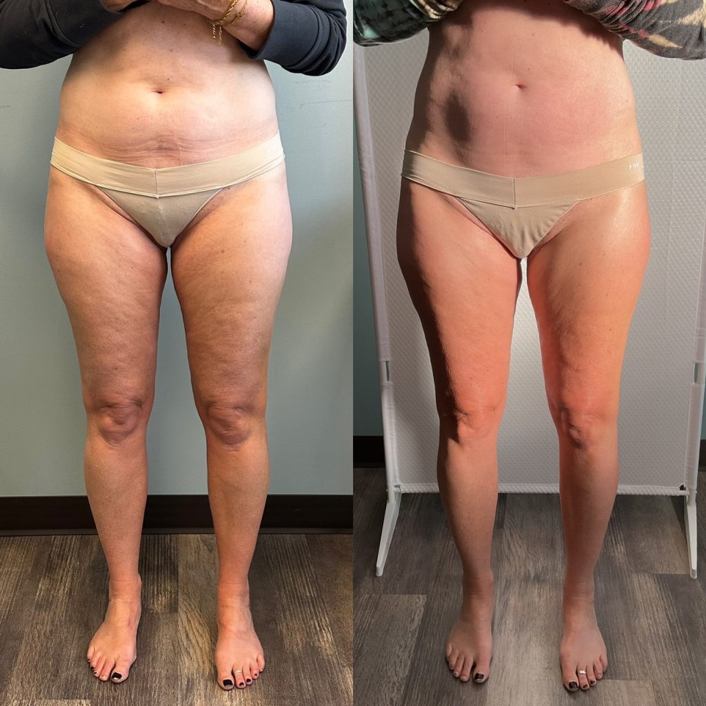 Artemis T-Shape 2 Before & After Patient #3956