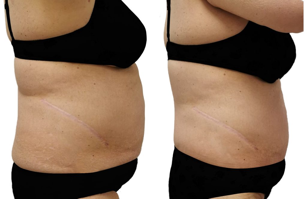 Artemis T-Shape 2 Before & After Patient #3957