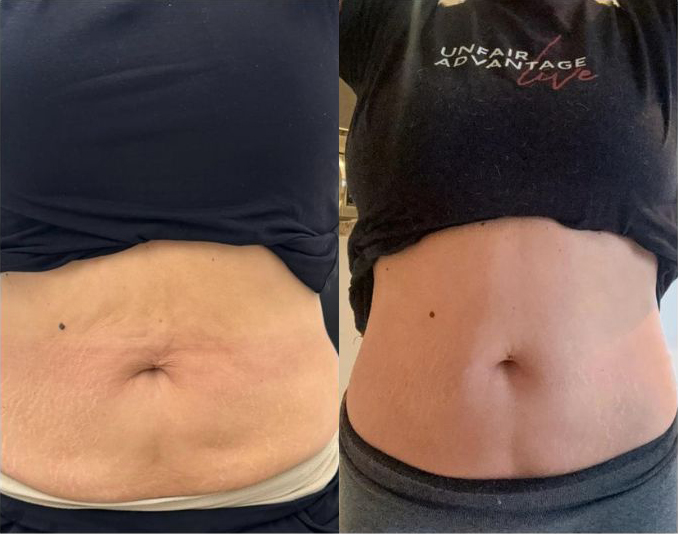 Artemis T-Shape 2 Before & After Patient #3959