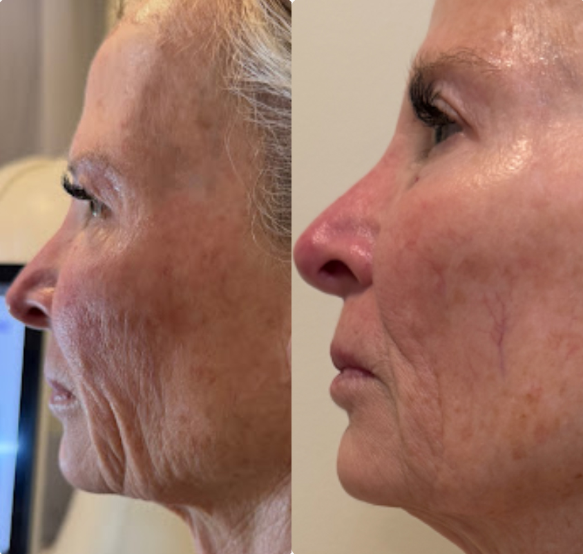 Artemis T-Shape 2 Before & After Patient #3960