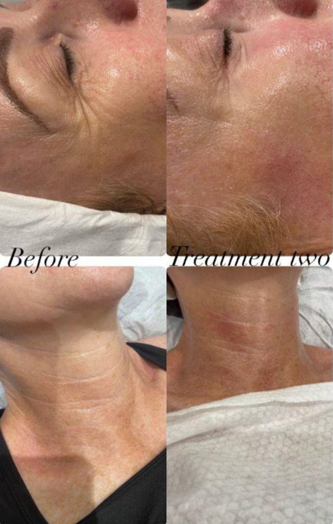 Artemis T-Shape 2 Before & After Patient #3962